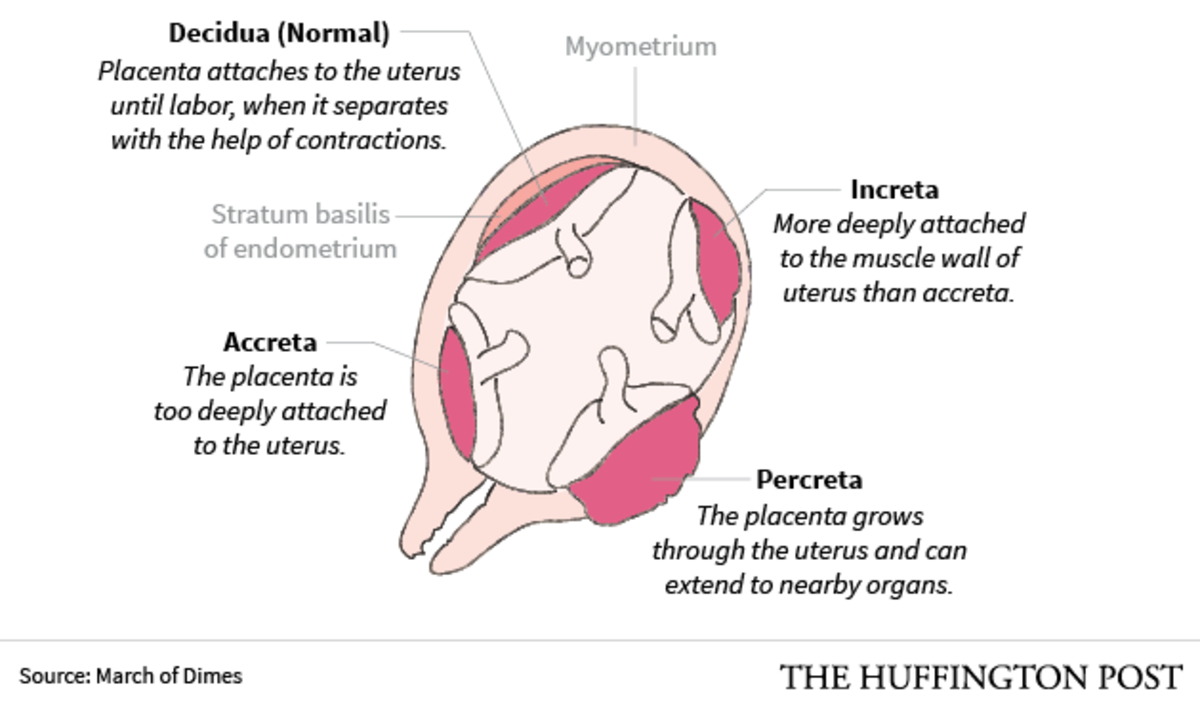 Placenta Acreta Increta E Percreta - RETOEDU