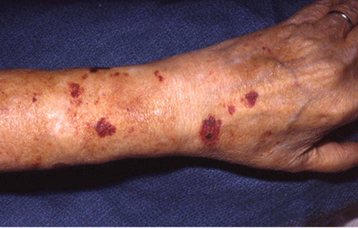 causes-of-senile-purpura-information-and-symptoms-of-senile-bleeding