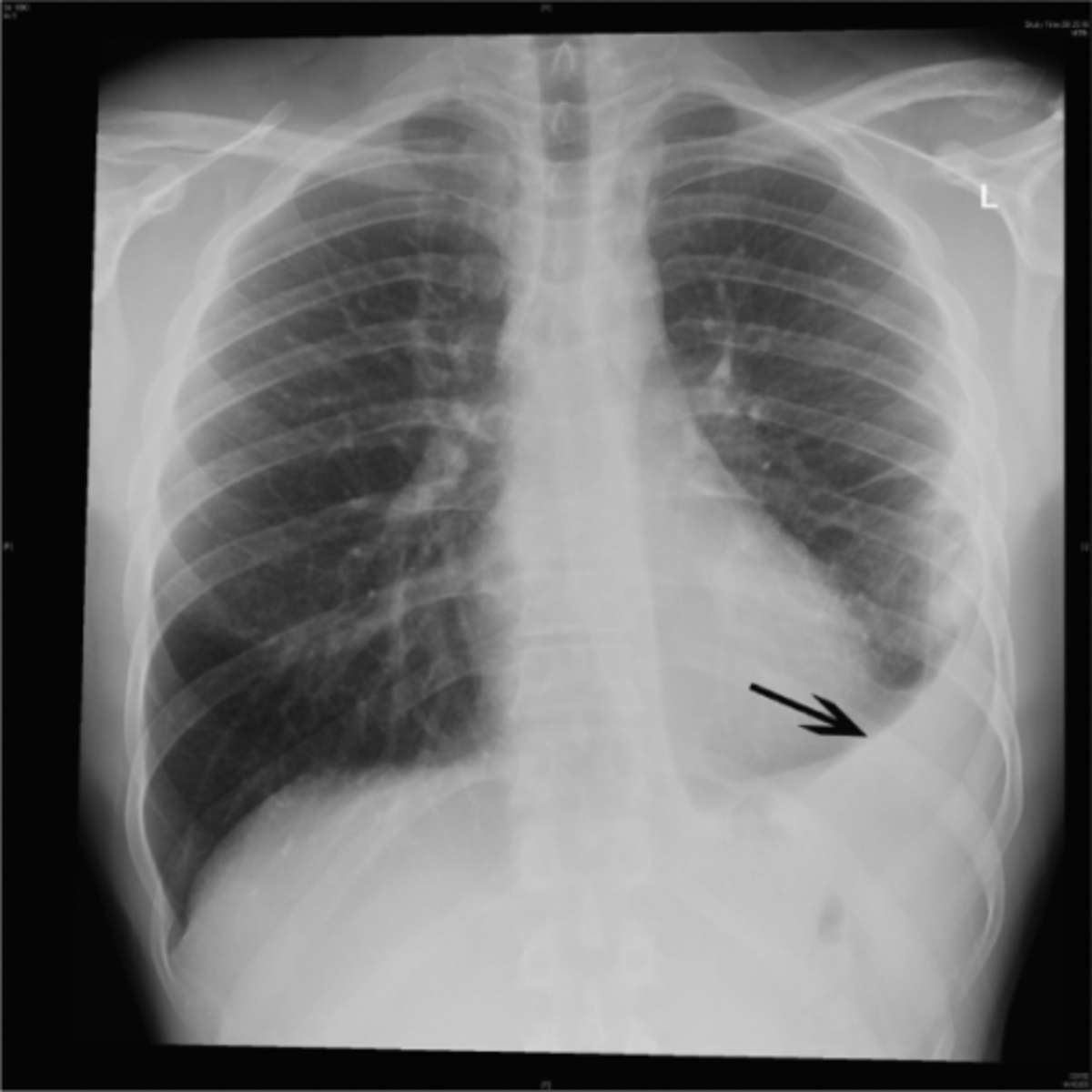 [DIAGRAM] Diagram Pneumonia X Ray - MYDIAGRAM.ONLINE