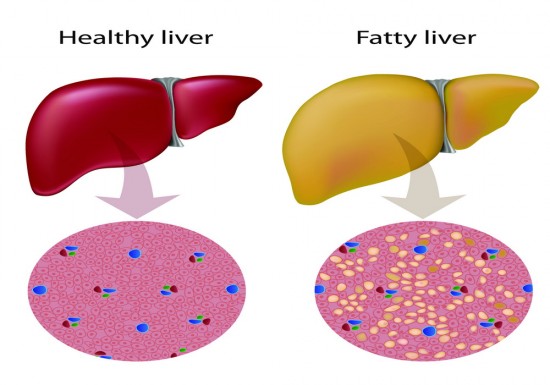 Fatty Liver: Treatment for Fat Accumulation in Liver Cells | Healthy ...