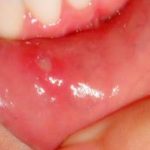 Canker Sore in Mouth Causes, Symptoms, Treatment