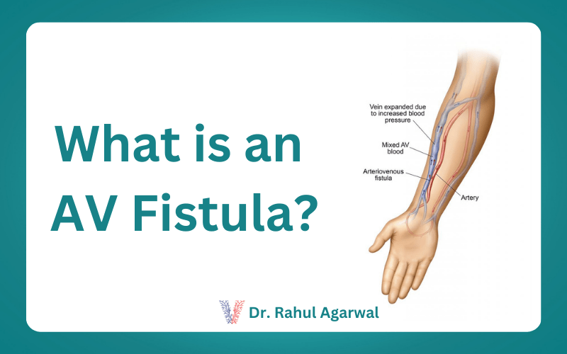 What is an AV Fistula