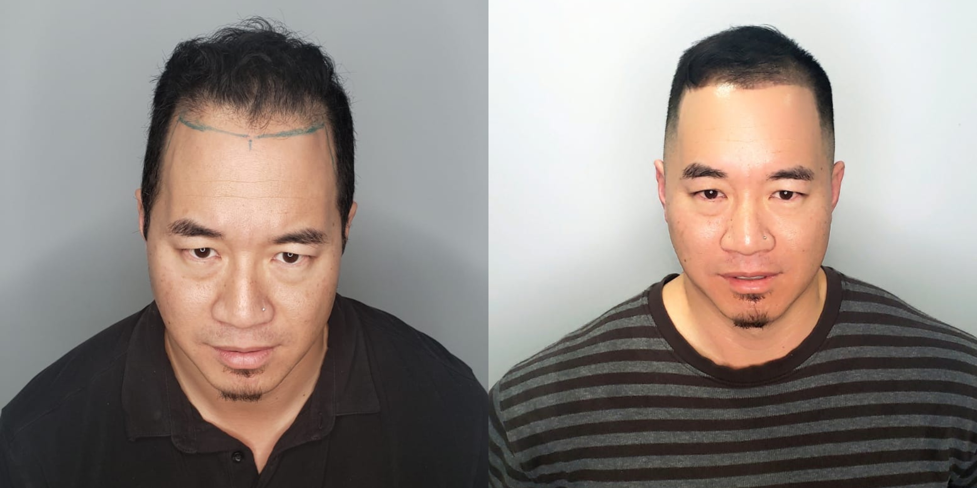 Scalp Micropigmentation Hair Tattoo Benefits Before  After