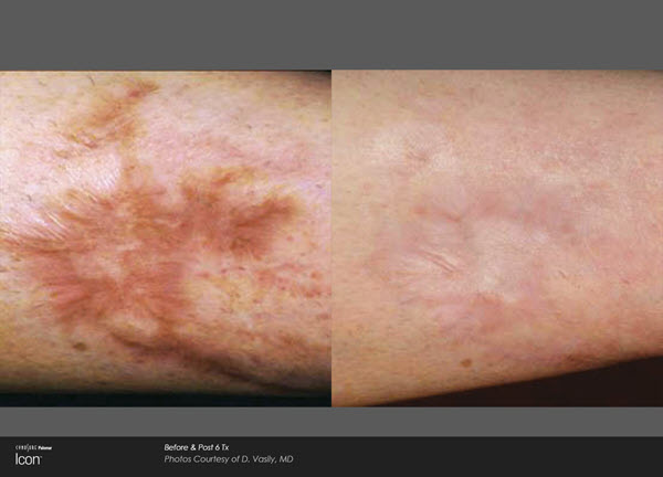 Scar Removal Before and After VINA Laser Med Spa Saginaw MI