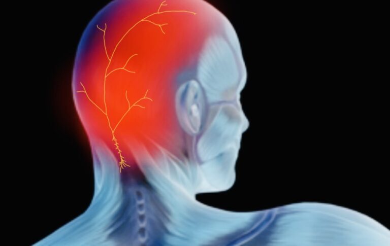 occipital neuralgia triggers - Virtual Headache Specialist