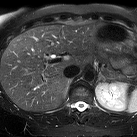 Normal Liver (T2- Weighted MR) [4 of 4]