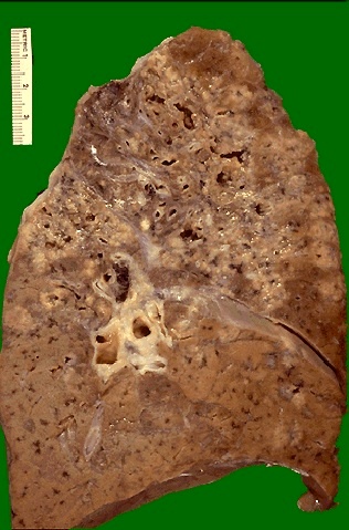 Pulmonary Pathology