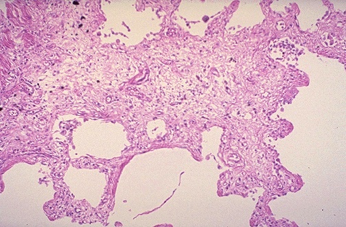 Pulmonary Fibrosis Histology