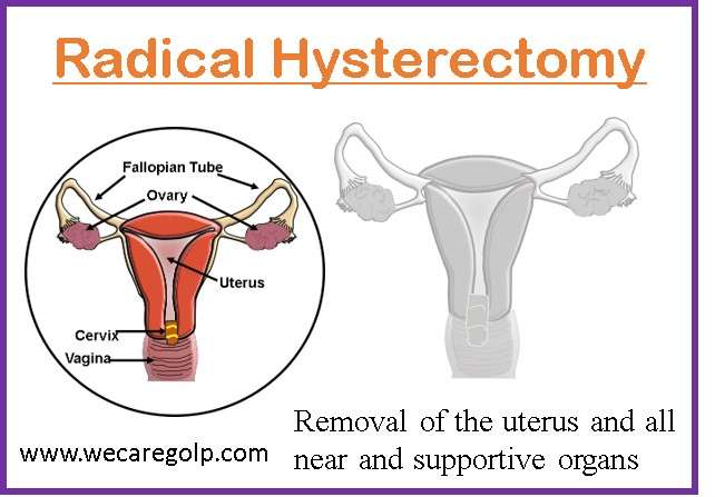 Hysterectomy: Types, Procedures, Complications - We Care