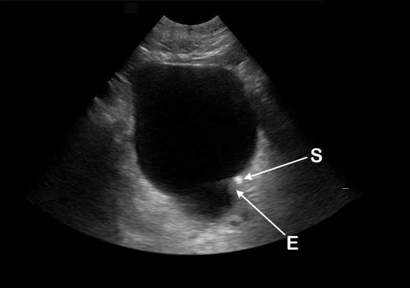 Bladder Stone Ultrasound