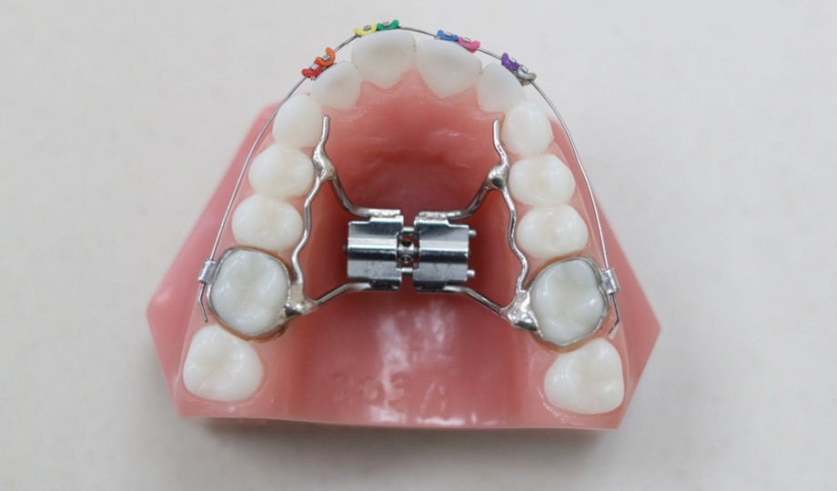 Palatal Expenders Darien