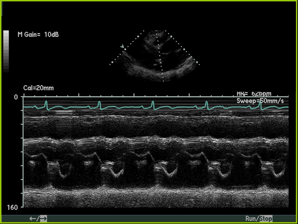 Mitral regurgitation echocardiography - wikidoc