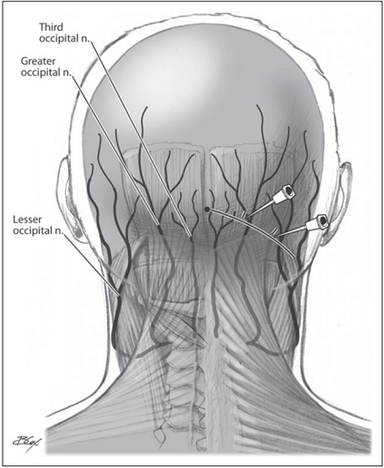 Occipital Nerve Block Injection