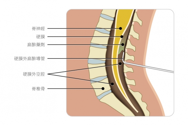 Breasts Surgery - Schematics of epidural anesthesia