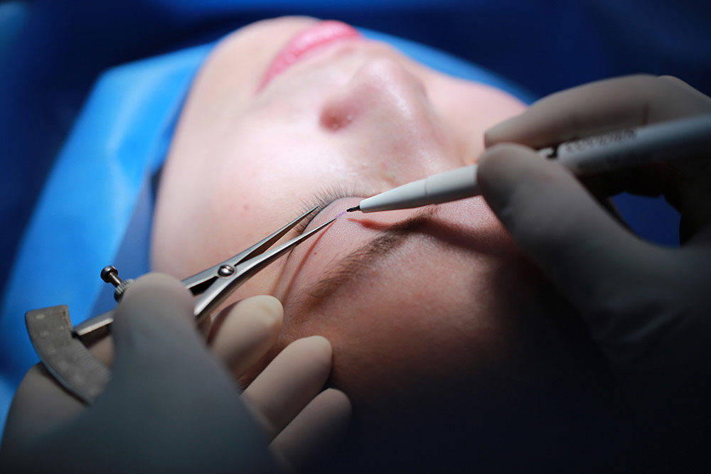 Eyelid - Blepharoplasty surgery