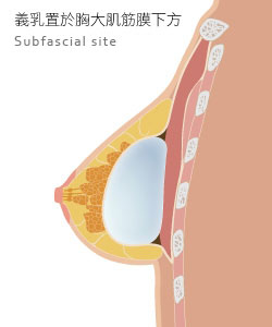 Breasts Surgery