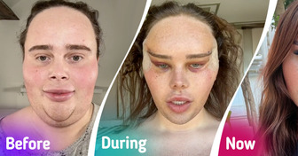 Influencer Reveals Dramatic Results of Her Fox Eye Plastic Surgery