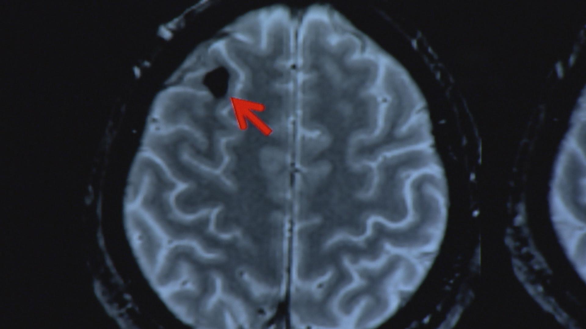 [DIAGRAM] Diagram Of Concussion Mri - MYDIAGRAM.ONLINE