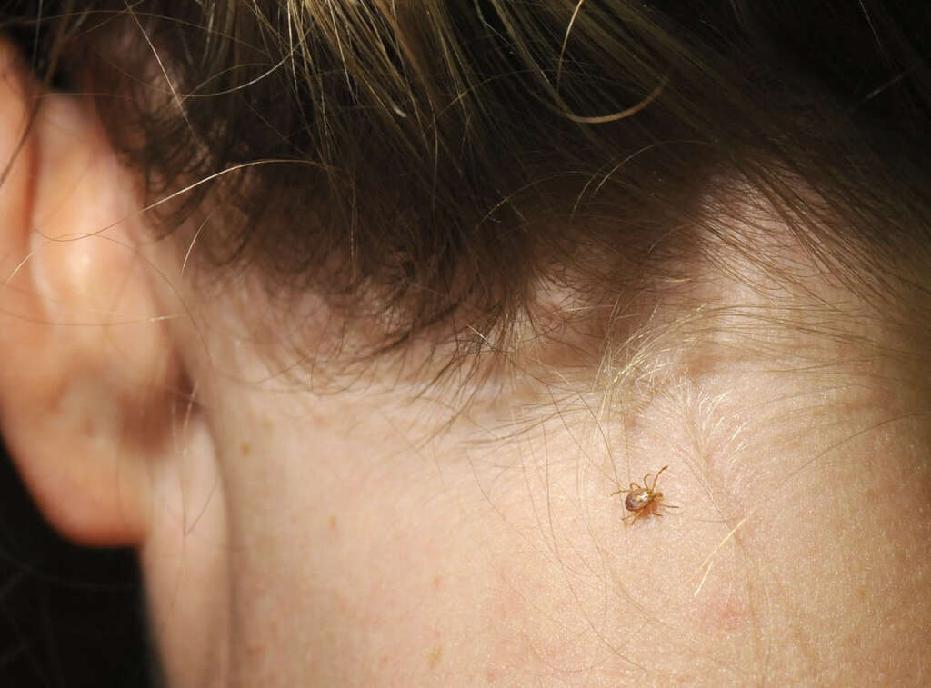 Lyme Disease: What Is Lyme Disease?