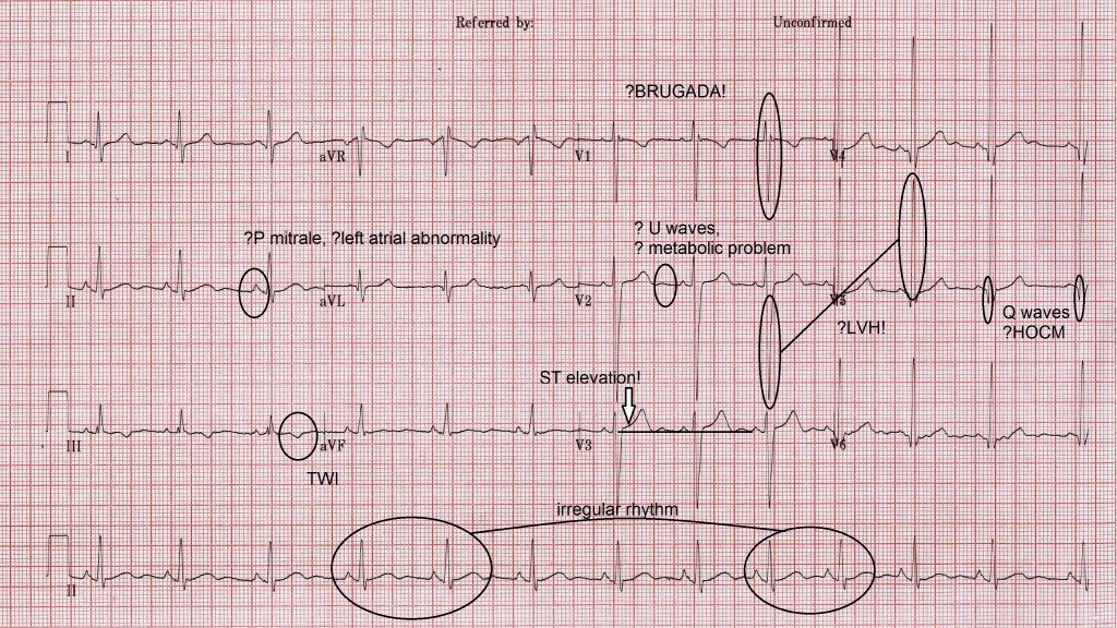 Lese en ung persons EKG - Topp 5 tips (2023)