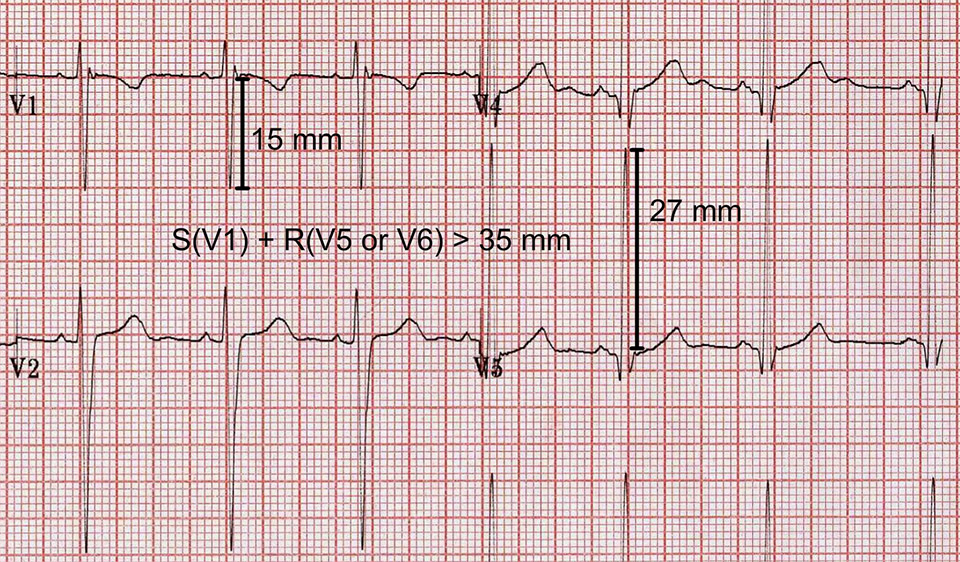 Ecg V1 V2 V3 Normal Best Shop | gbu-presnenskij.ru