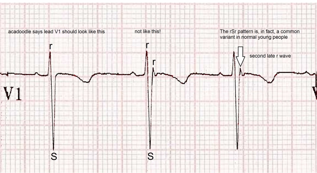 Lese en ung persons EKG - Topp 5 tips (2023)