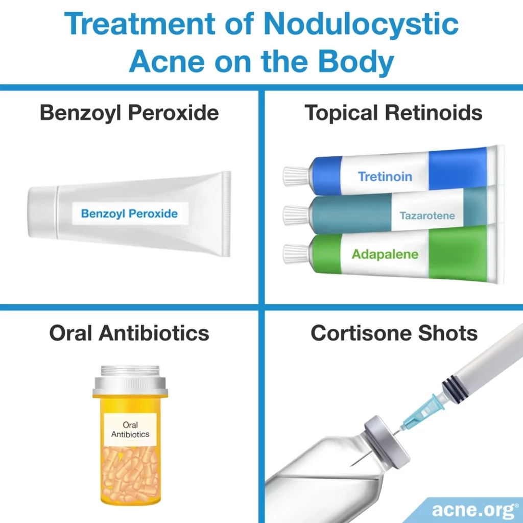 Treatment of Nodulocystic Acne on the Body