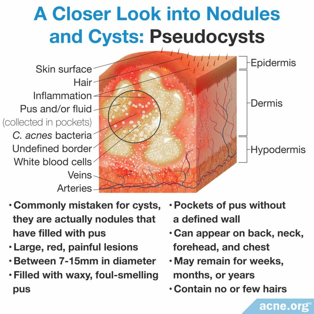 Pseudocyst