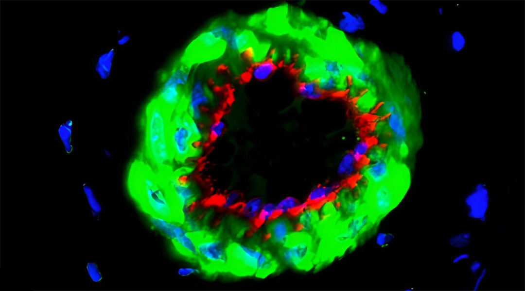 Tiny vesicles could help prevent amputations in diabetic patients