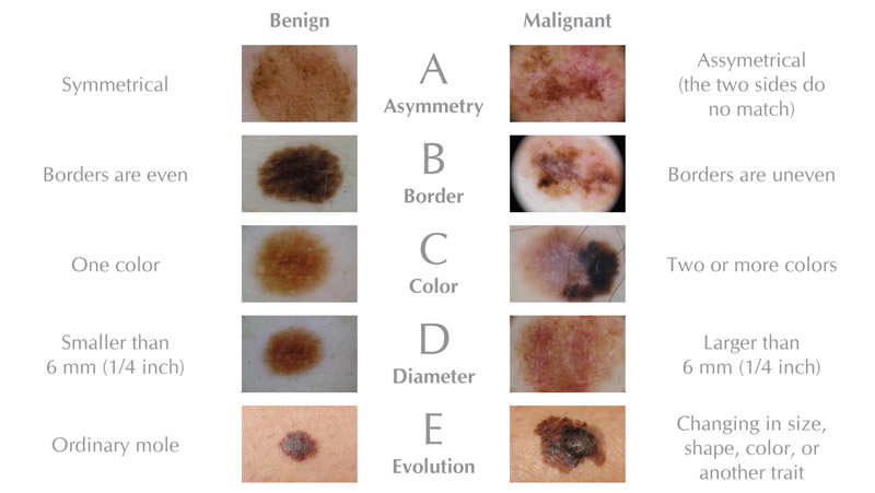 Conozca el ABCDE - AIM en la Fundación para el Melanoma