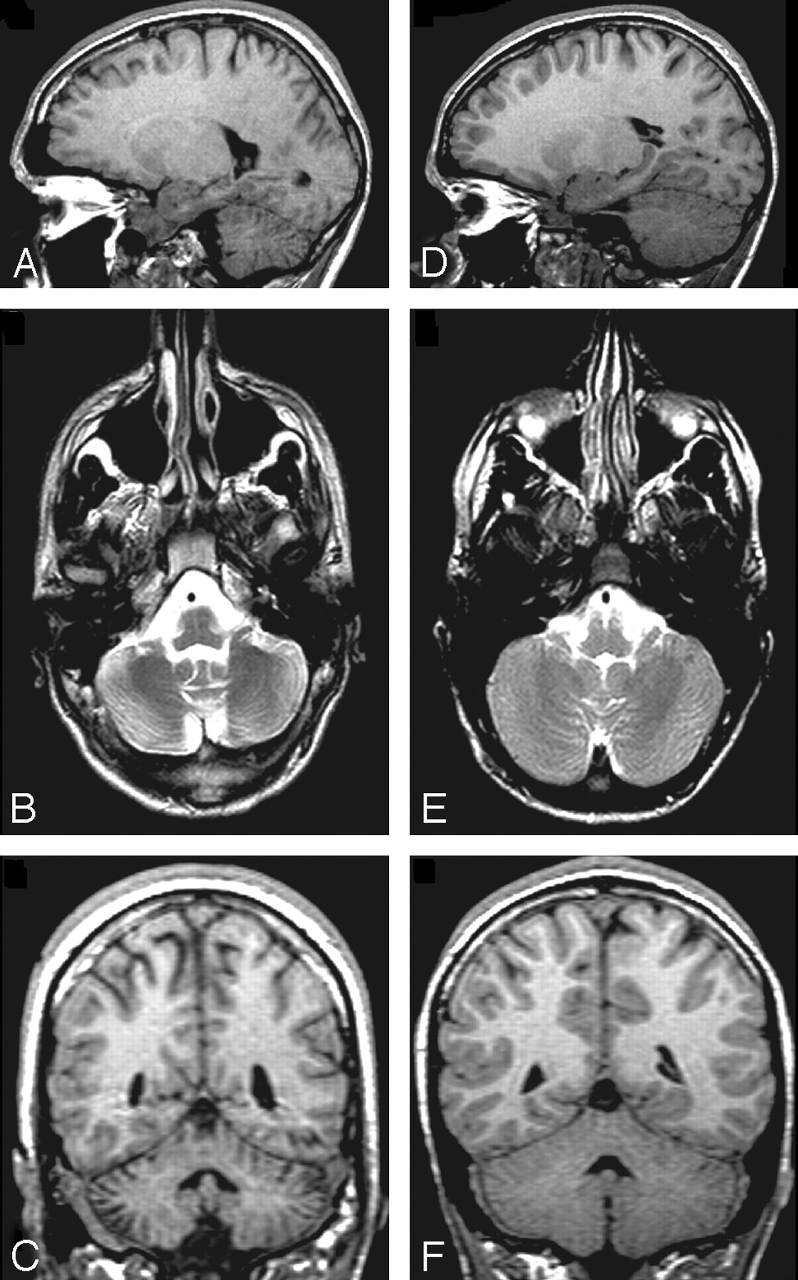 Cerebellar Atrophy after Moderate-to-Severe Pediatric Traumatic Brain ...