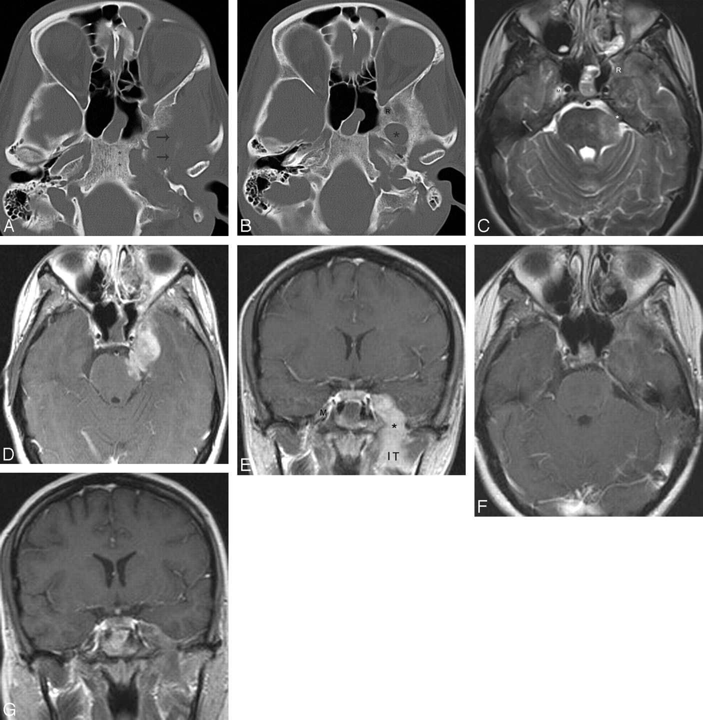 Inflammatory Pseudotumor of the Trigeminal Nerve: A Neoplastic Mimic ...