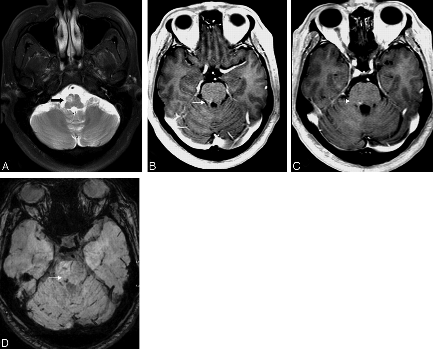 Diffusion Tensor Imaging in Hypertrophic Olivary Degeneration ...