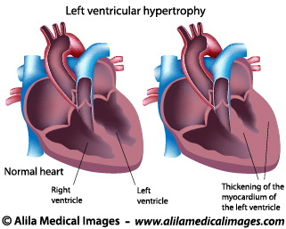 Heart, Blood and Circulation Gallery - Medical Information Illustrated