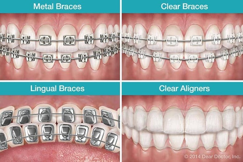 Teeth Braces And It's Types