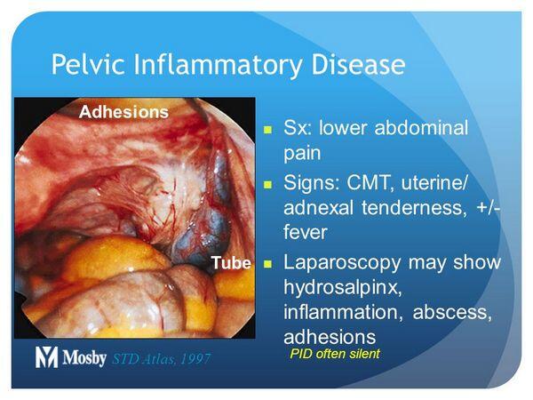 Acute Pelvic Inflammatory Disease Pid Medical Special - vrogue.co