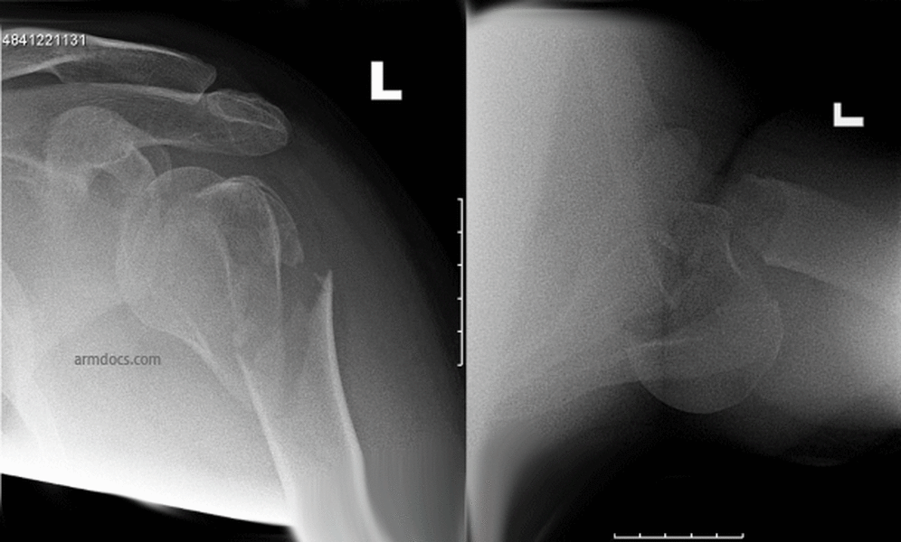 Proximal Humerus Fracture - Operative Fixation | Arm Docs