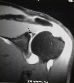 Mri Shoulder Labrum Tear