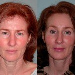 Facelift and Neck Lift before and after