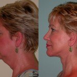 Facelift and Neck Lift before and after on a woman