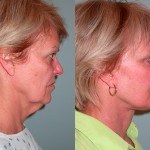 Facelift and Neck Lift before and after