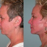 Facelift and Neck Lift before and after