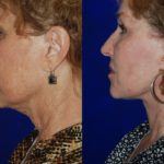 Facelift and Neck Lift before and after