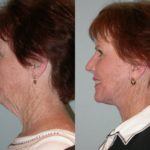 Facelift and Neck Lift before and after