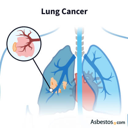 Asbestos Cancer - Mesothelioma, Lung Cancer & Other Cancers