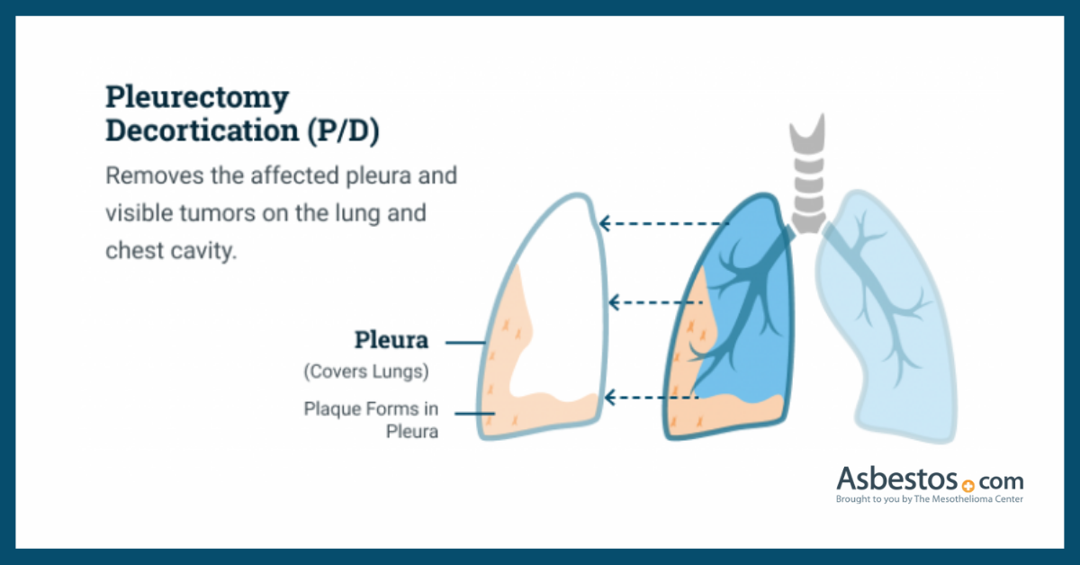 Pleurectomy and Decortication: Definition and What to Expect