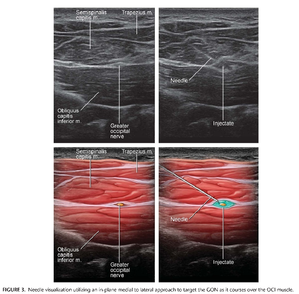 Occipital Nerve Block