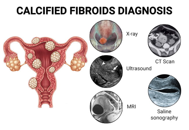 Uterine Fibroids Ultrasound