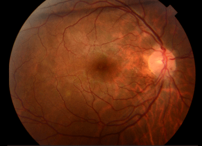 Posterior Scleritis Simulating a Vogt-Koyanagi-Harada Syndrome