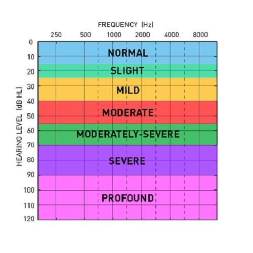 Audiogram with hearing levels color coded